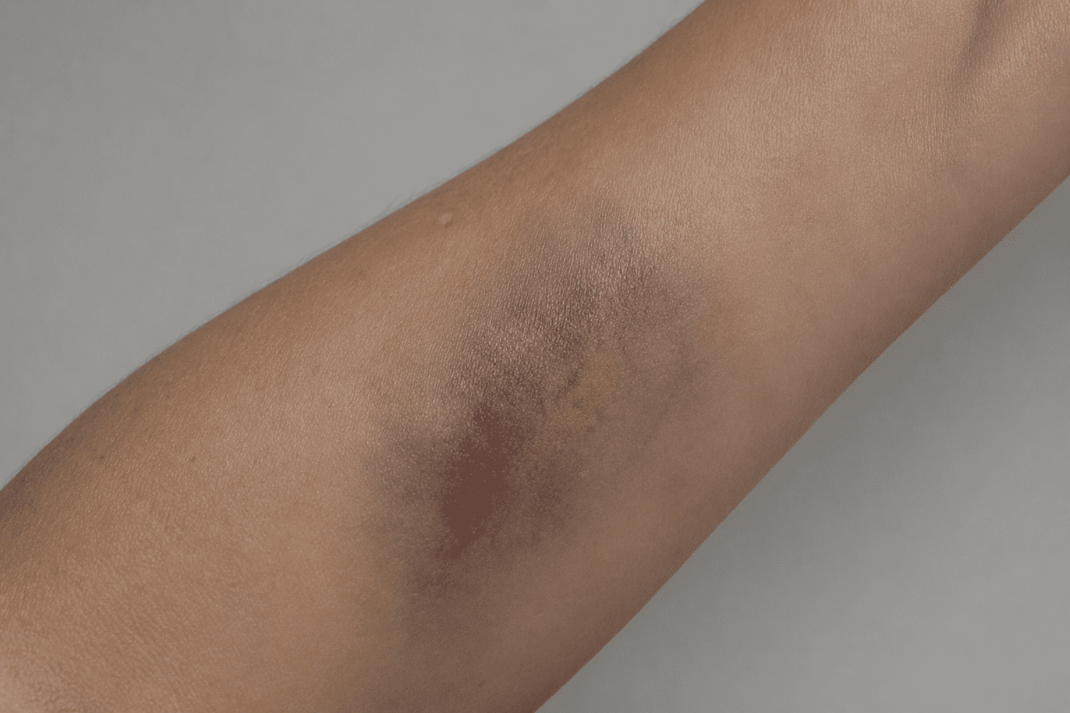 Bruising and Discoloration
