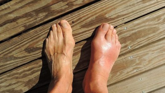 feet-gout-symptoms.jpg
