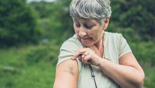 A senior woman in nature is looking at a bruise on her arm